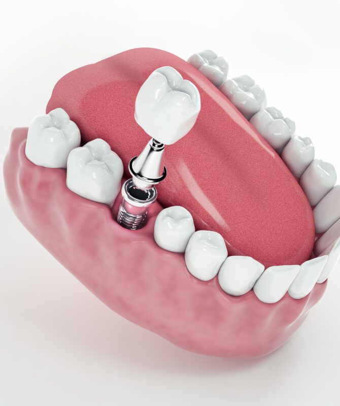 Une technique de pointe pour les dents artificielles – la garantie de la  qualité VITA - Vue détaillée des communiqués de presse