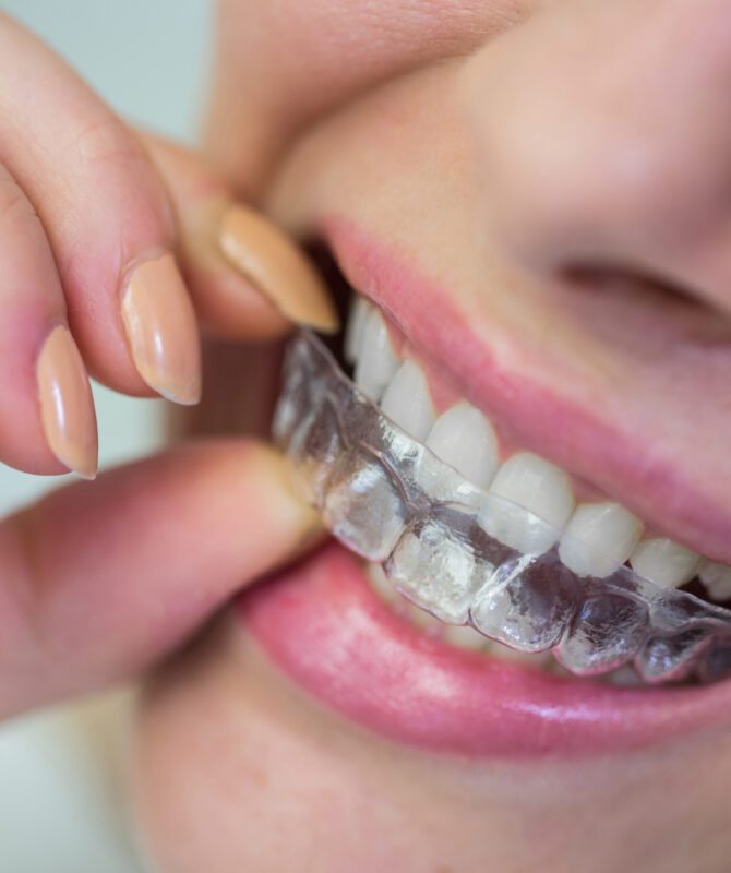 Close-up of woman wearing orthodontic silicone invisible braces